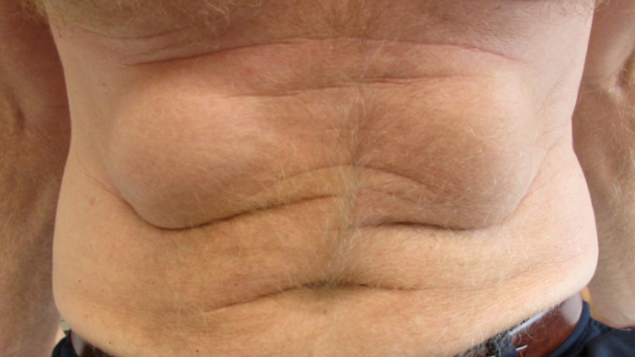 UC Irvine researchers identify surfer chest growths