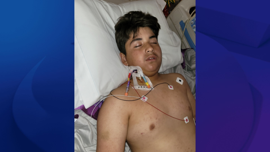 Long Beach boy hospitalized with rare West Nile complication
